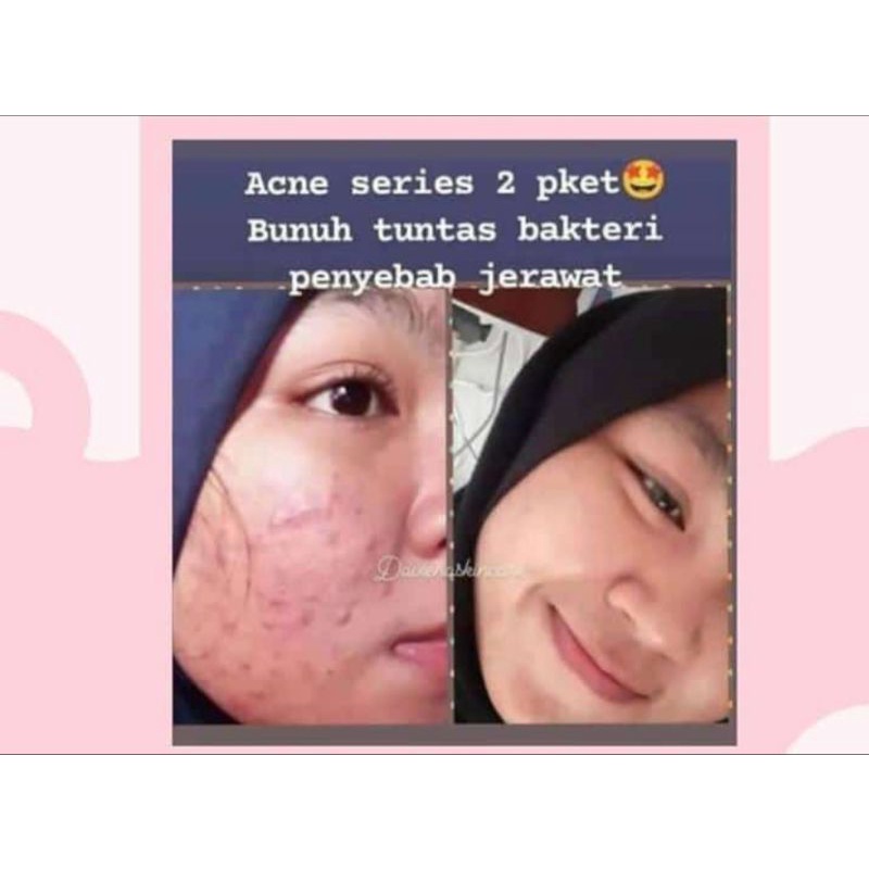 Daviena Skincare Paket Acne Series Davienaskincareofficial Davina Devina Lampung Surabaya Jakarta Jerawat Pencerah Pemutih Wajah Glowing Bpom Daviena Skincare-4