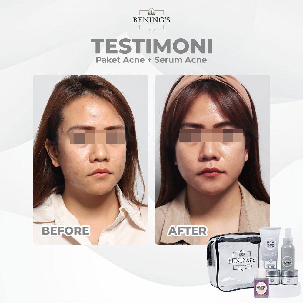 Bening Skincare Dr Oky Pratama Paket Acne Terbaik (Free Gift) Benings Skincare - Benings Clinic Paket Jerawat-6