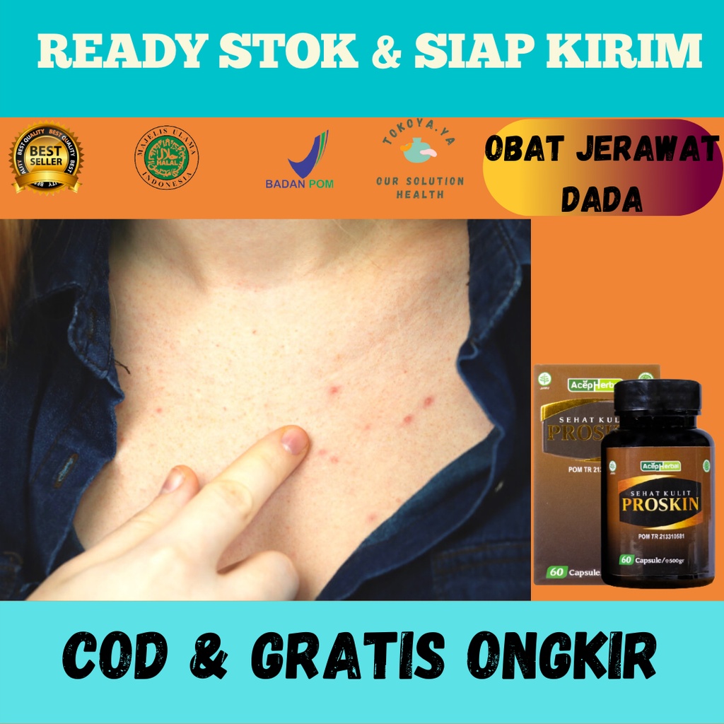 PROSKIN 100% ORIGINAL BPOM, Obat Jerawat Dada, obat jerawat di punggung, dada dan badan, Obat Herbal