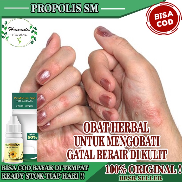Obat Gatal Berair Di Kulit, Obat Gatal Berair di Jari Tangan dan Kaki, Obat Gatal Bintik Berair,  Ob