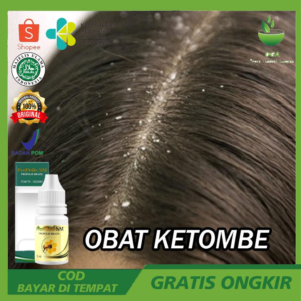 Obat Ketombe Parah Salep Borok Kulit Kepala Berkerak Gatal Kulit Kepala Berkerak Kering Bau Rambut G