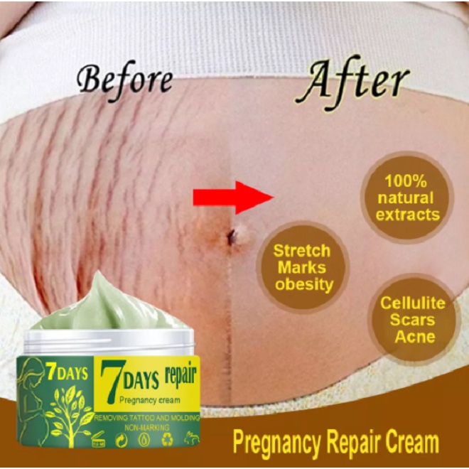 Stretch Mark Penghilang Kerutan Di Perut dan Kaki 7 Days