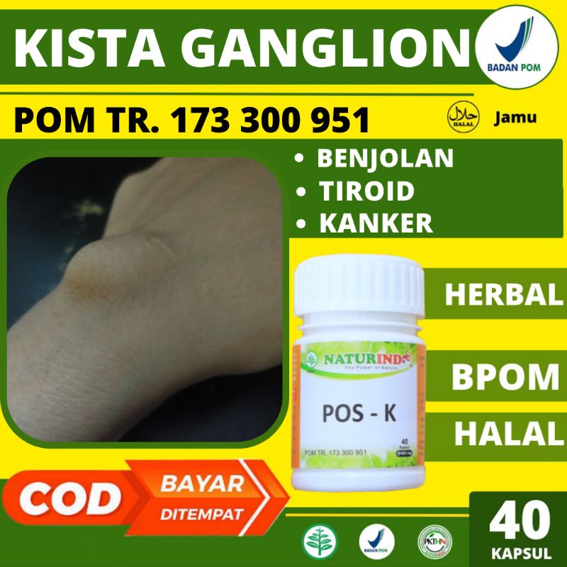 Obat Kista Ganglion Di Tangan Atau Pergelangan Tangan Sendi Tangan Benjolan