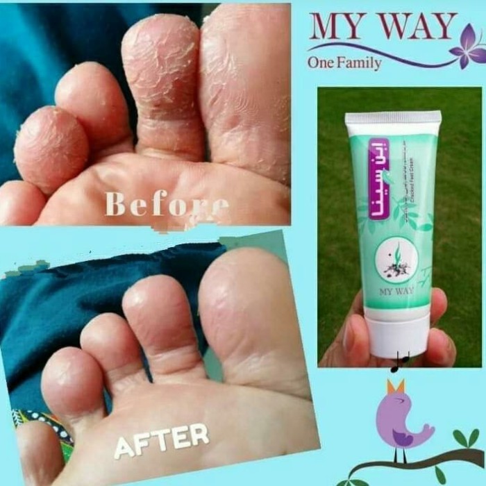 My Way TERMURAH     TERMURAH Ibnu Sina ibn Sina my way cracked feet kaki tanga pecah gatal