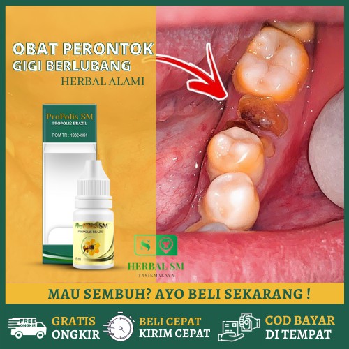 Obat Perontok Gigi Sampai Ke Akar Penghancur Gigi Berlubang Karang Gigi Keropos Propolis Sm Shopee Indonesia