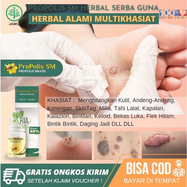 Salep Penghilang Keloid, Hilangkan Keloid Membesar dan Gatal, Obat Untuk Menghilangkan Keloid Yang S
