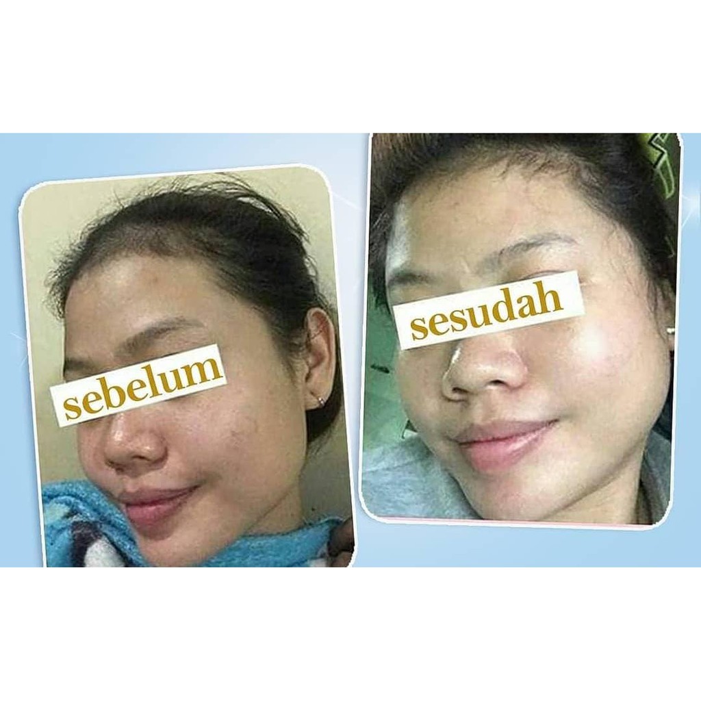 SABUN WAJAH BERJERAWAT DR PURE ACNE CARE BEAUTY BRIGHTENING SOAP BPOM - SABUN JERAWAT DR PURE