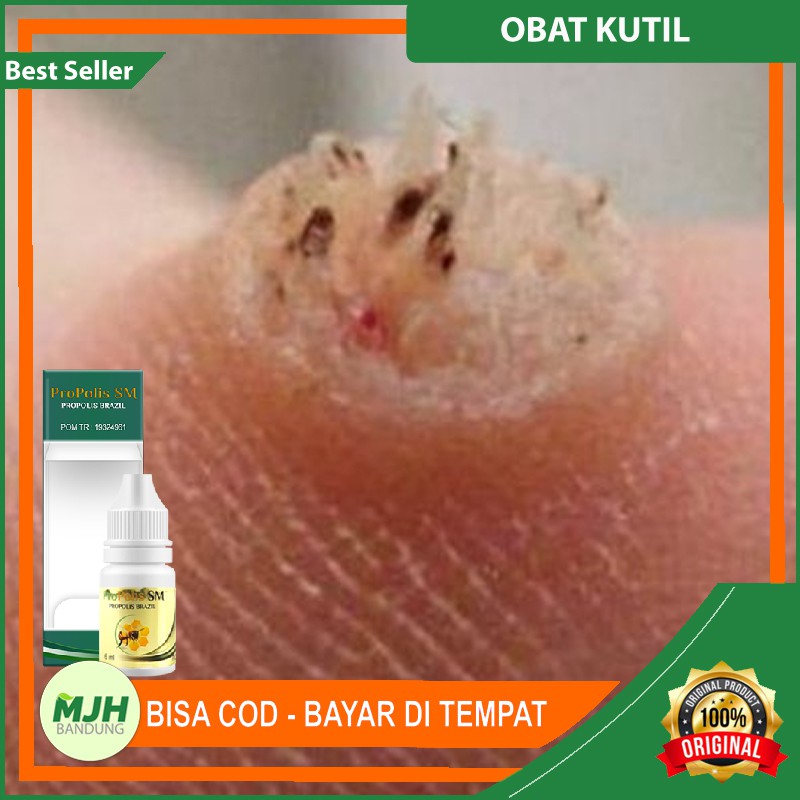 Obat Kutil di Leher, Kelopak Mata, Wajah, Tangan, Kaki, dan Tubuh