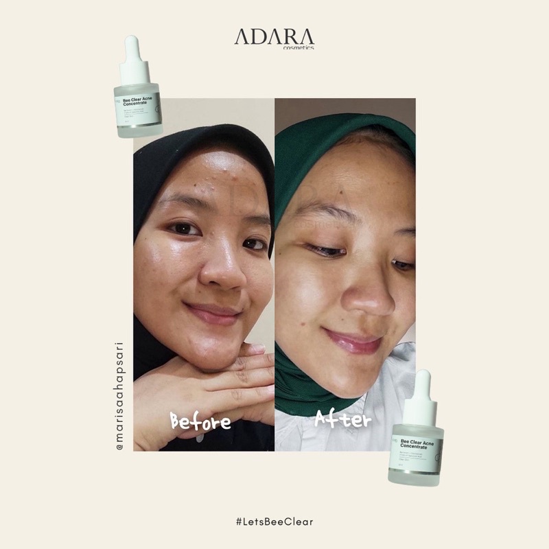 ADARA Bee Clear Acne Concentrate Serum 20ml (Bee Venom + TR Salicylic Acid + 3HA Serum)