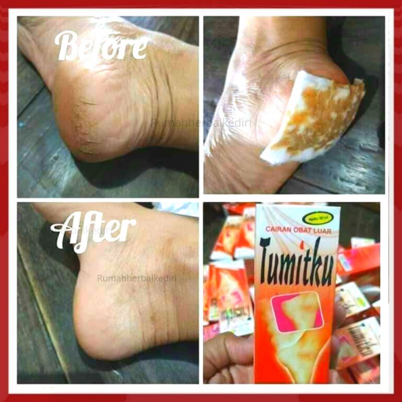 Obat Herbal BPOM Original Asli Solusi Kaki Pecah Kapalan Obat