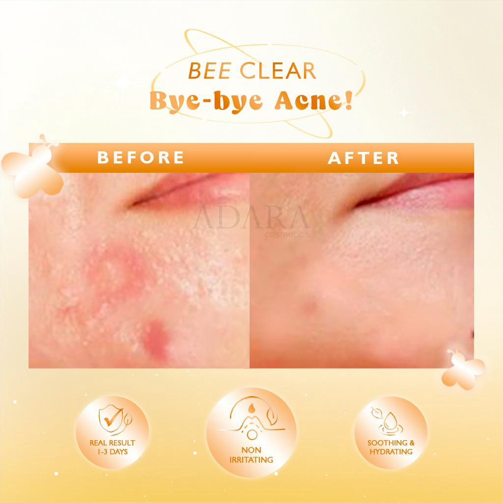 [Best Seller Acne Bundle] ADARA - Enzyme Wash + Acne Gel Extra Formula + Spotless Gel/Cream