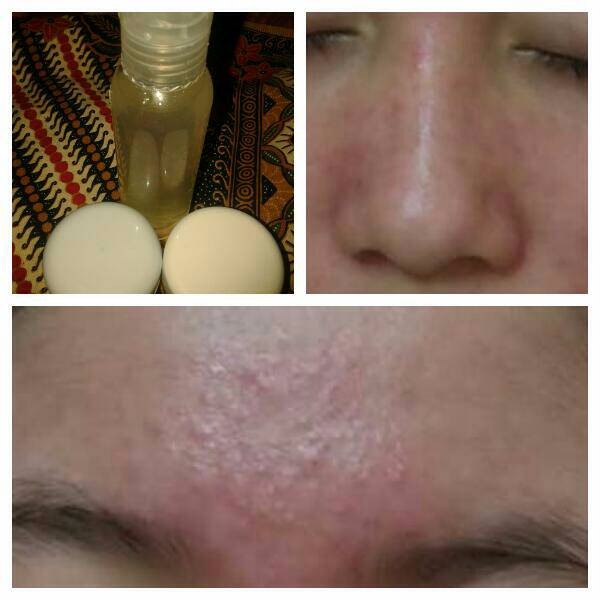 PAKET ACNE WHITENING AMPUH