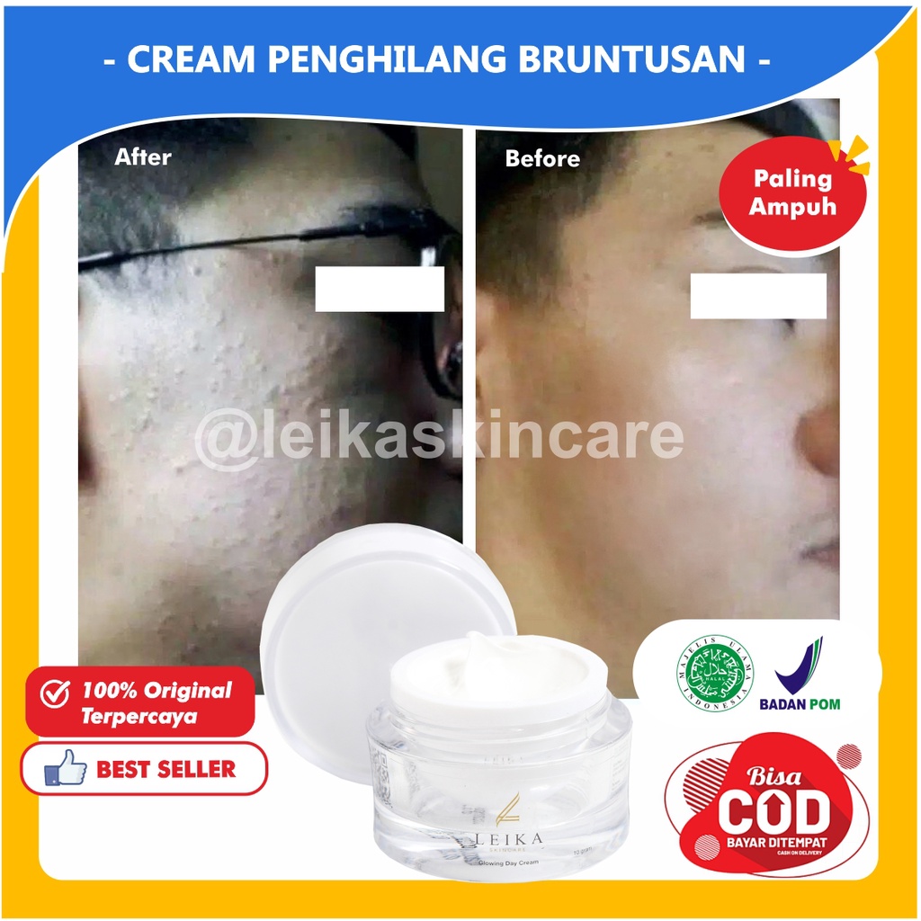 Krim Bruntusan Pria Ampuh Penghilang Bruntusan Dan Bekas Jerawa Bpom Obat Bruntusan Wajah Paling Amp