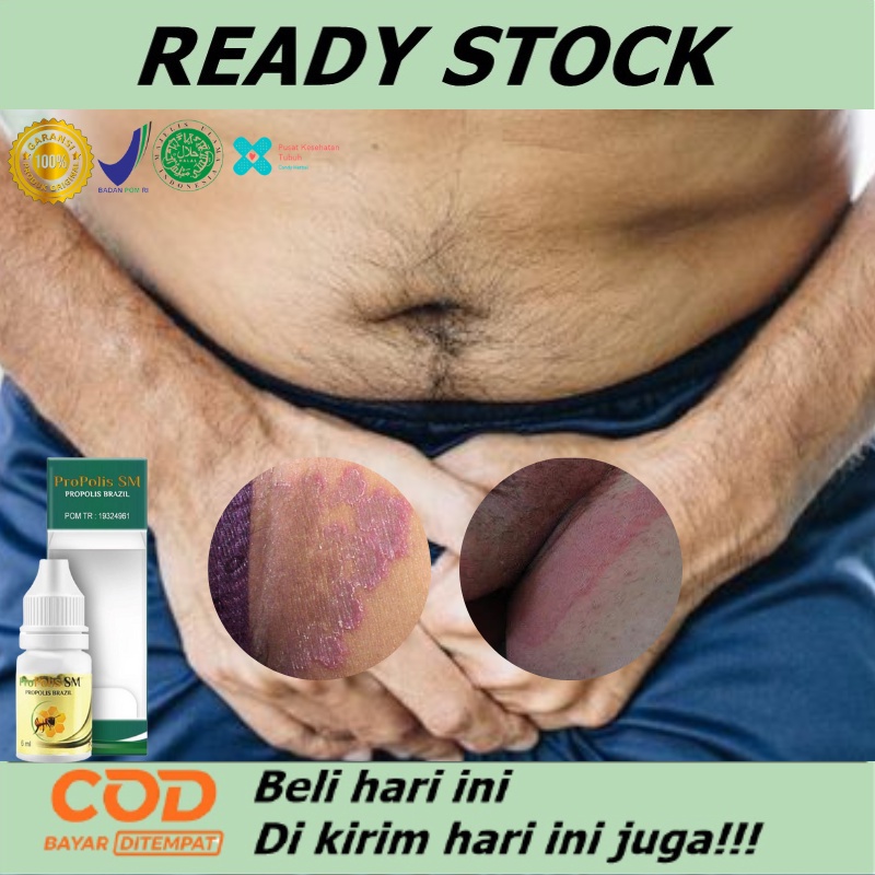 Obat selangkangan lecet berjamur - Obat selangkangan - Obat Oles Selangkangan Hitam/Gatal - Obat Tin