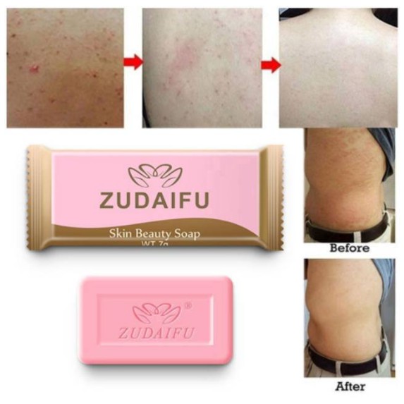 Zudaifu Sabun Gatal Eksim Psoriasis Jamur Kudis Panu Sabun Zudaifu 7g