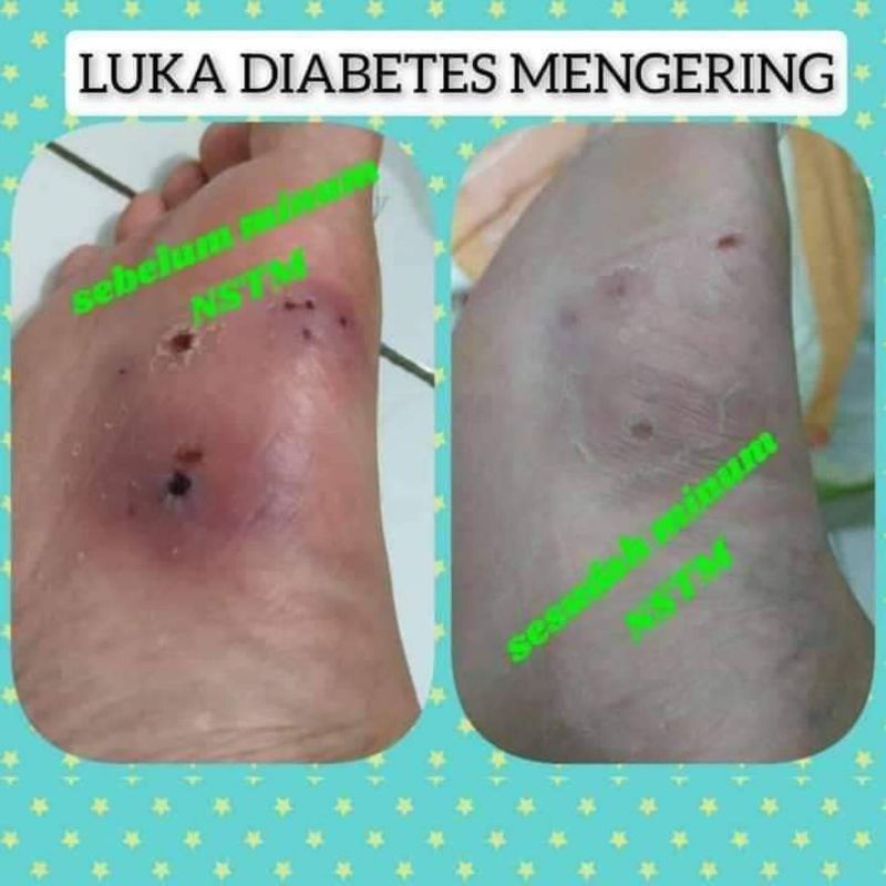 NSTM nasa // Obat Herbal//Alami