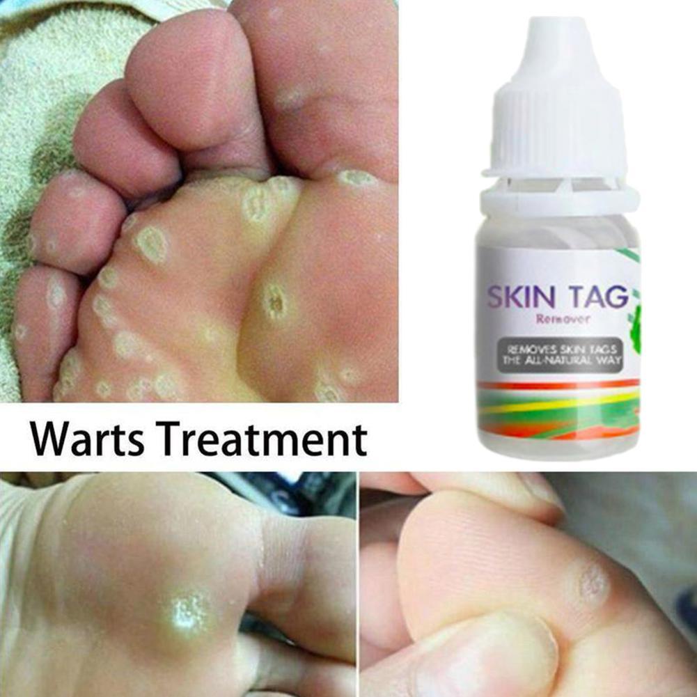 SKIN TAG Penghilang Kutil dan Tahilalat Obat Kutil Obat Merontokan Kutil Kemaluan Penghilang 10ml