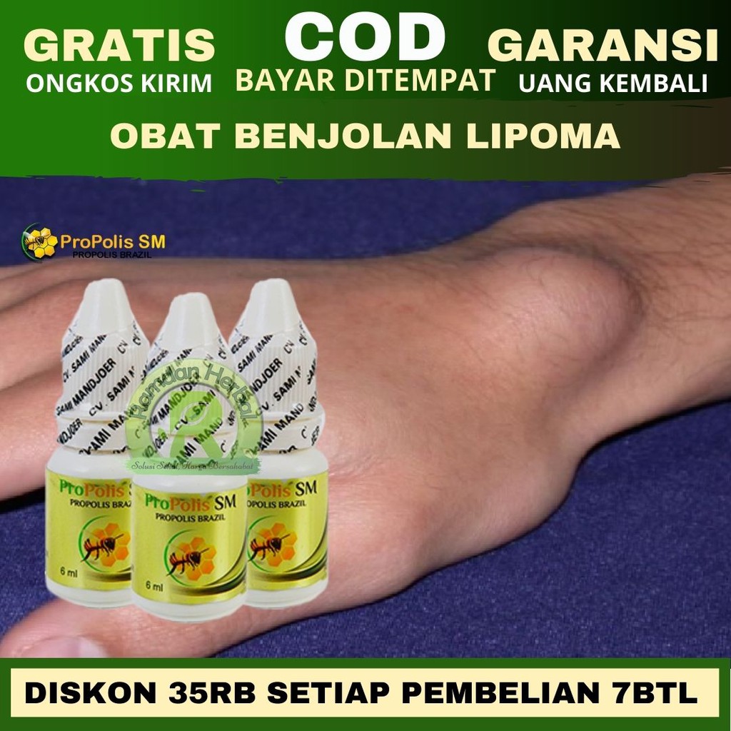 Obat Alami Benjolan Ganglion,Kista Ganglion,Obat Benjolan Ganglion Murah Propolis SM HALAL