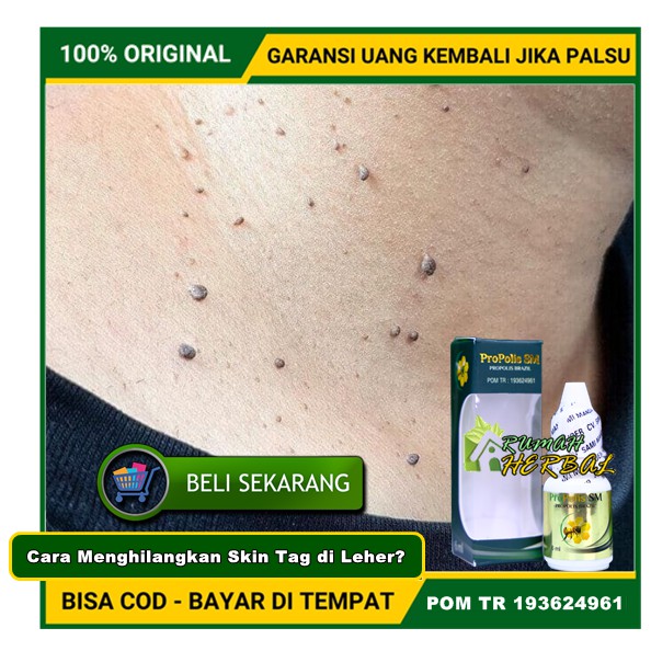 Cara Menghilangkan Skin Tag di Leher?Obat Herbal Penumpas Skin Tag Kutil Papiloma Daging Tumbuh~Jadi
