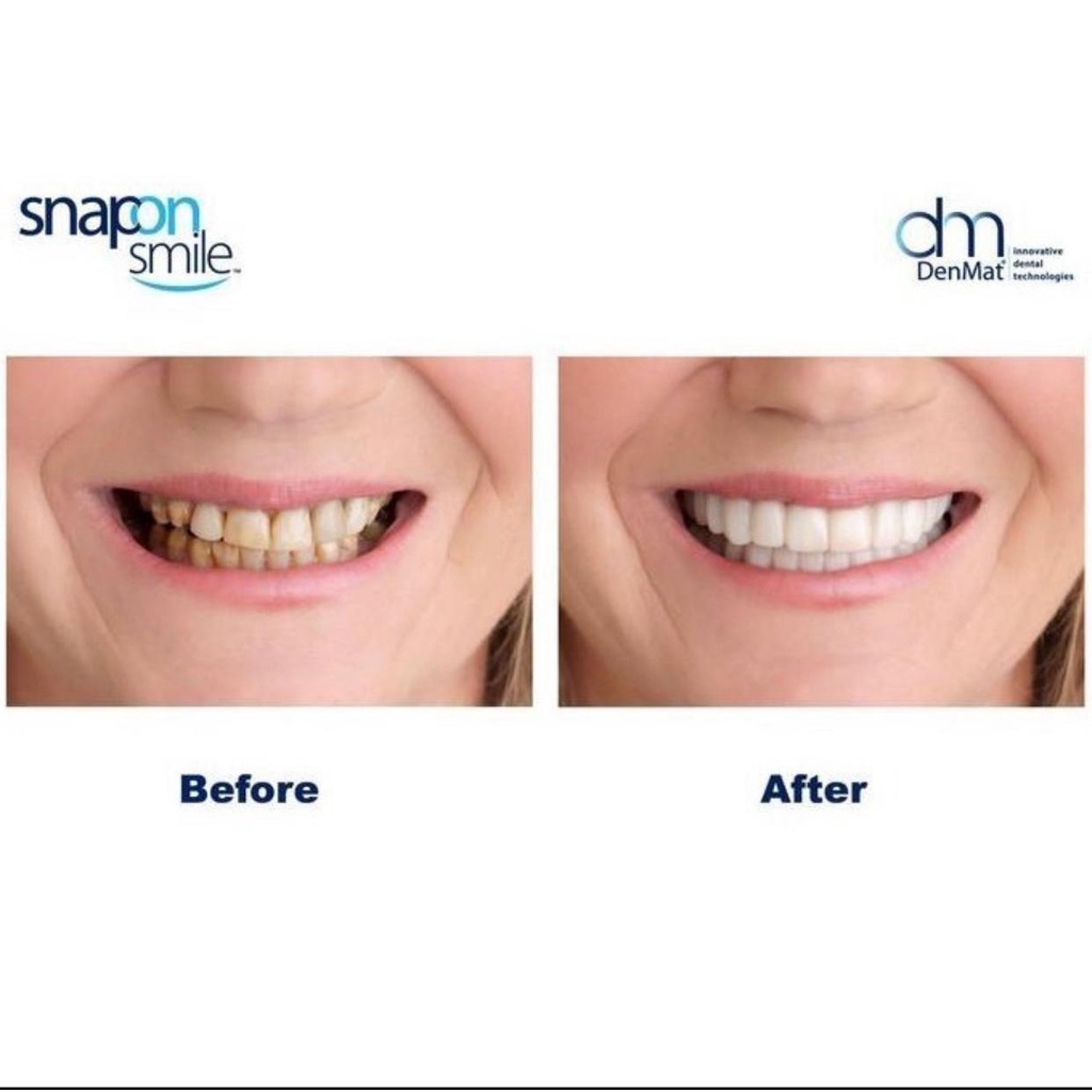 Snap On Smile 100% Original Veneer Gigi Palsu Atas Bawah Instan Gigi Palsu Vener Silikon Alami Authentic Pemutih Gigi