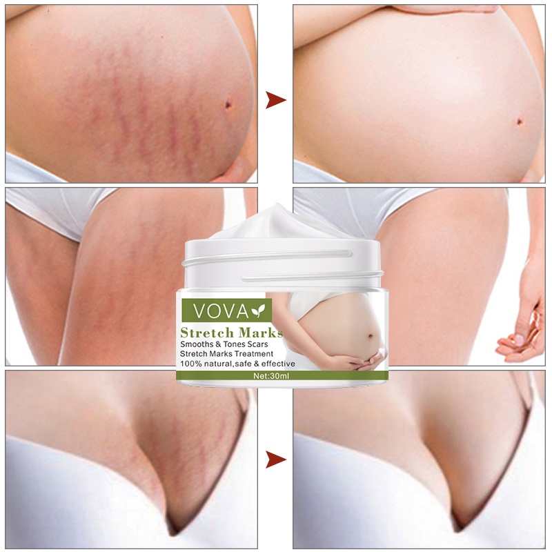 VOVA Stretch Mark Removal Cream Efektif Menghilangkan Bekas Luka Kehamilan Krim Jerawat Bersalin Anti Aging Winkles Perbaikan Firm Body Cream