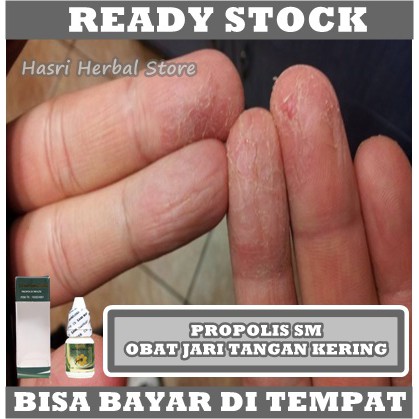 Obat Jari Tangan Kering, Obat Oles Kulit Jari Mengelupas, Obat Telapak Tangan Kasar, Salep Jari Tangan Gatal, Obat Kulit Jari Pecah Pecah, Gatal Berair, Ruam Gatal Gatel, Kuman Air / Kutu Air Dengan ProPolis SM