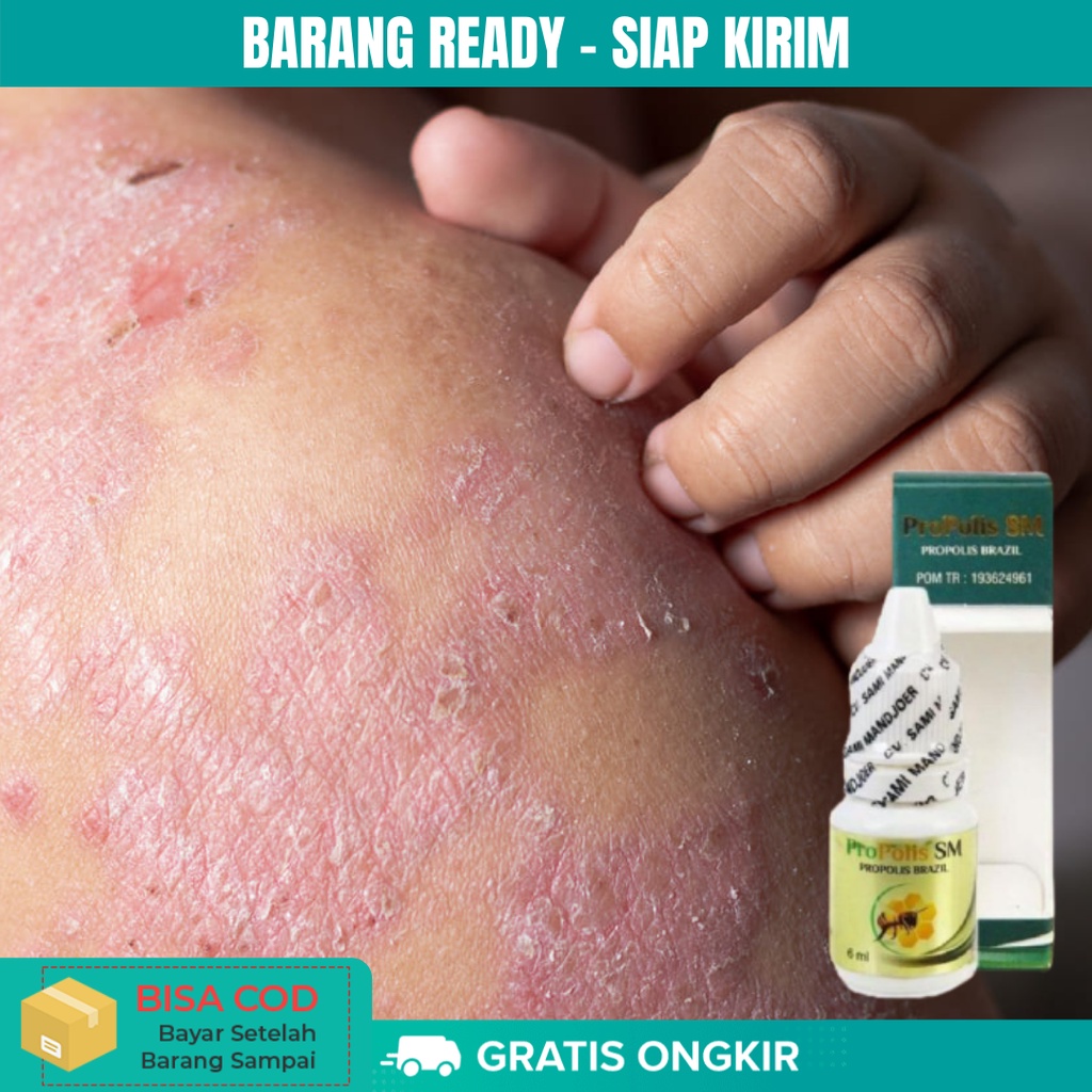 Obat Eksim Obat Gatal Selangkangan Obat Kurap Obat Kulit Obat Eksim Basah Kering Propolis SM