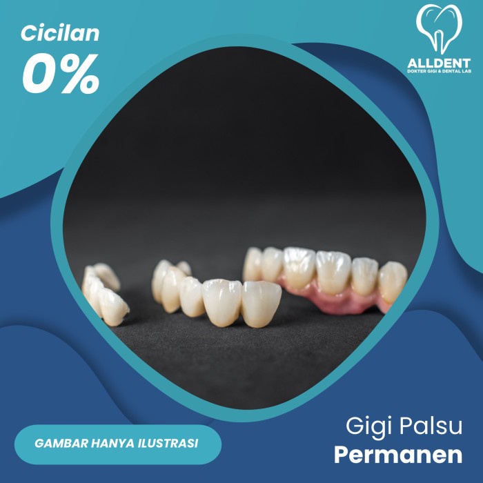 {PhilipsStore} Gigi Palsu Permanen Crown - Metal Porcelain Limited