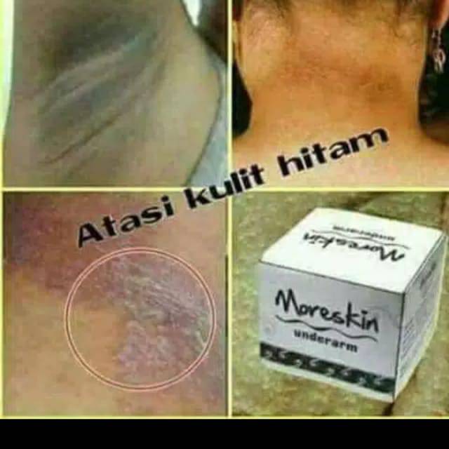 

Moreskin underarm ( cream pencerah bagian tubuh yg hitam )