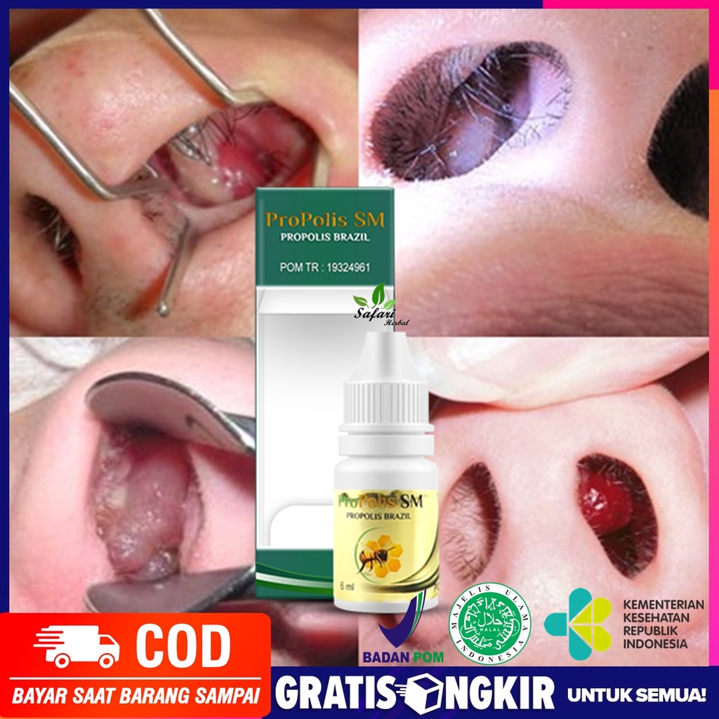 (Original) Obat Benjolan Di Dalam Hidung, Obat Konka Hidung, Obat Polip Hidung, Obat Hidung Berair,