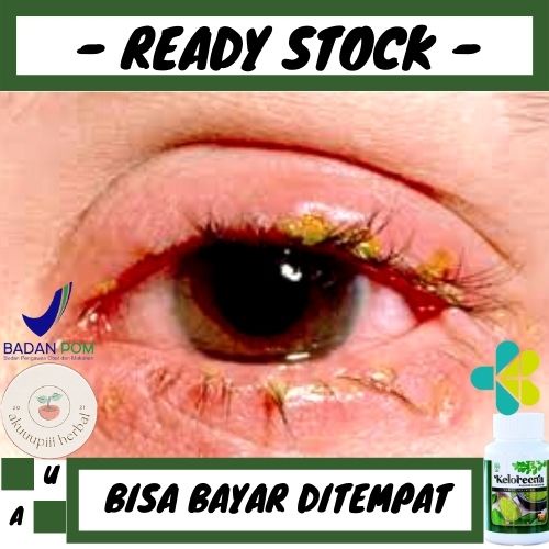 OBAT RETINOPATI HIPERTENSI, OBAT STORE MATA, OBAT PENYUMBATAN PEMBULUH DARAH DIMATA - HEBAL KELORENA