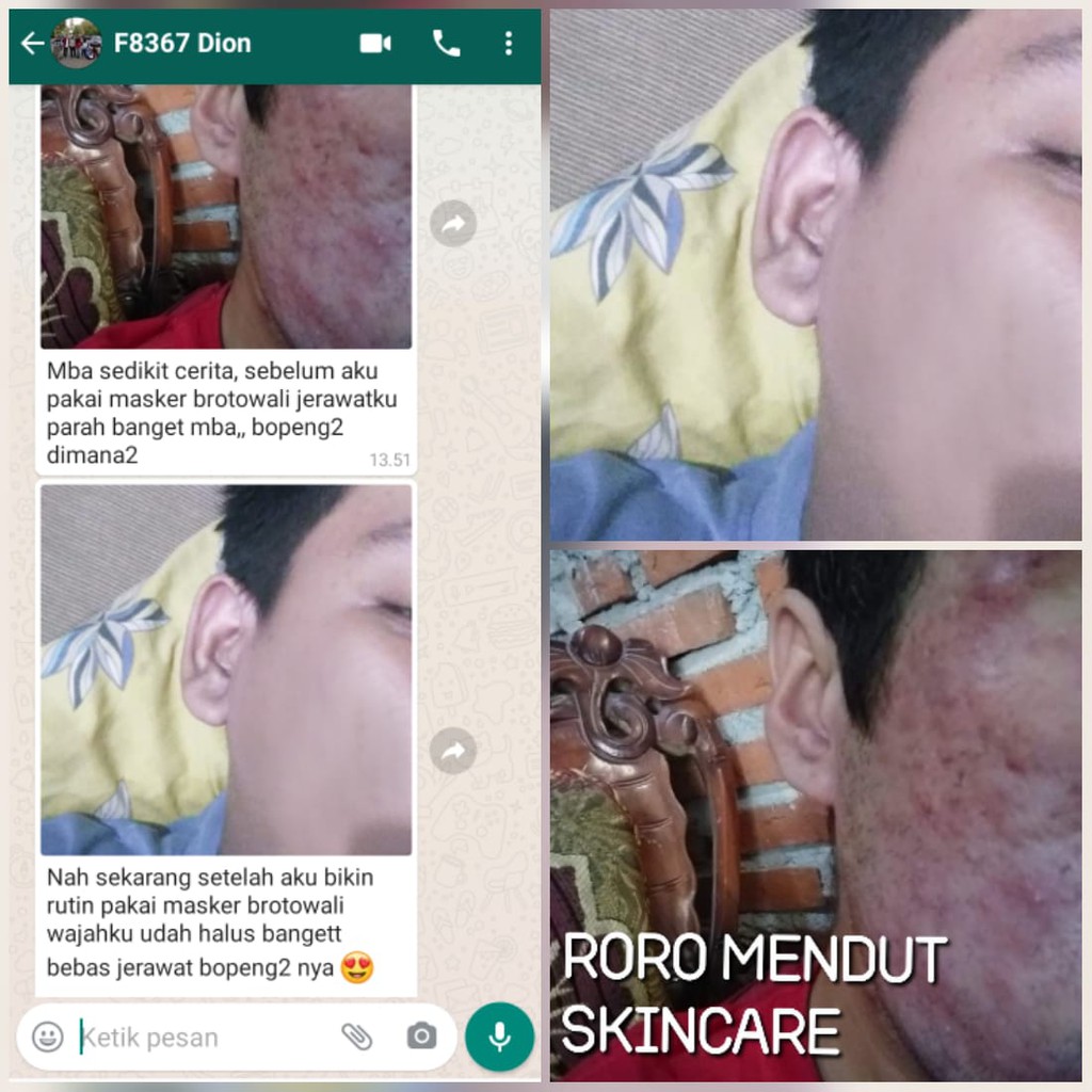 Masker Brotowali Penghilang Jerawat Bekas Jerawat Pencabut Komedo Roro Mendut Mini Acne Jerawat 20gr