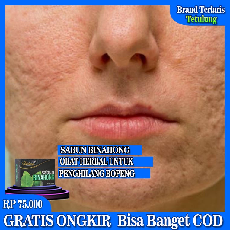 Sabun Binahong, Obat Bopeng, Obat Penghilang Bopeng Di Wajah, Obat Bopeng Bekas Jerawat Ampuh, Obat 