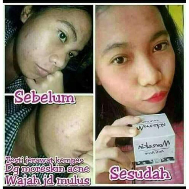 

paket_anti_jerawat
