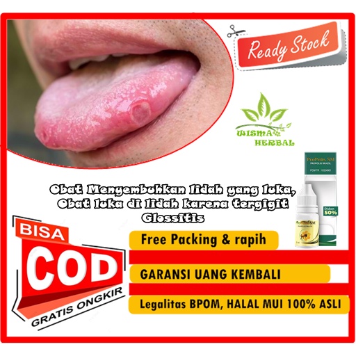 Obat Menyembuhkan lidah yang luka, Obat luka di lidah karena tergigit, Glossitis, Obat lidah luka sa