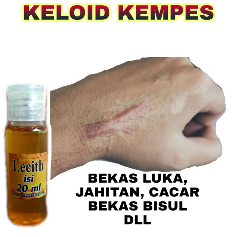 Penghilang keloid ampuh