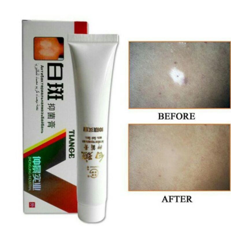 Original Salep Vitiligo Bercak Putih Bahan Herbal