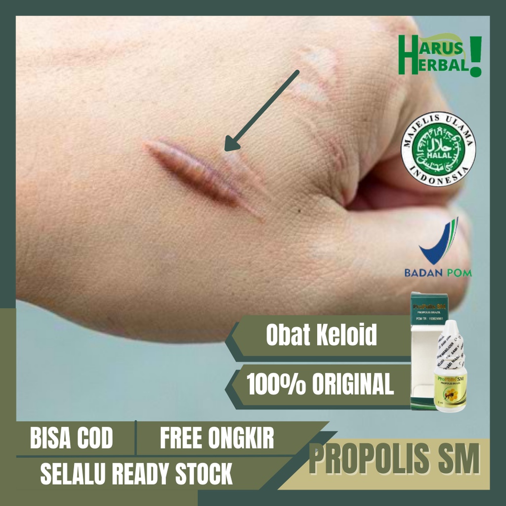 Obat Penghilang Keloid, Daging Jadi, Benjolan Bekas Luka, Obat Keloid Pasca Operasi, Obat Keloid Men