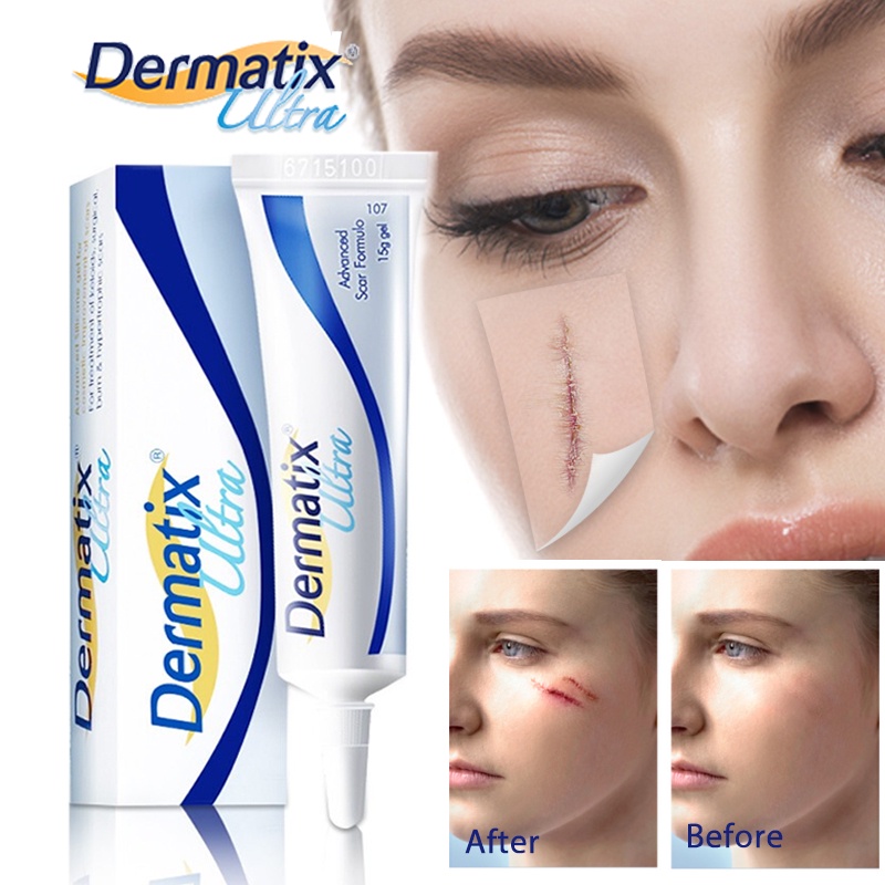 Dermatik Ultra Gel/ Dermatic /Menghilangkan Stretchmark / Bekas Luka Keloid 15gr