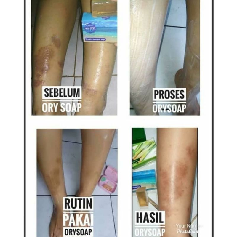 SABUN GATAL KULIT PALING AMPUH UNTUK ANAK DAN DEWASA / HILANGKAN BEKAS LUKA
