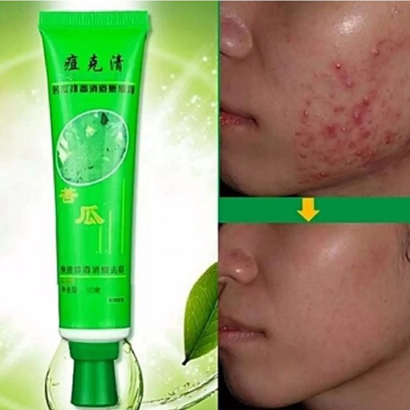 KRIM HILANGKAN PARUT JERAWAT AMPUH ACNE CREAM REMOVAL PERAWATAN KULIT WAJAH KRIM SALEP BEKAS JERAWAT BOPENG BISUL KOMEDO-30ml