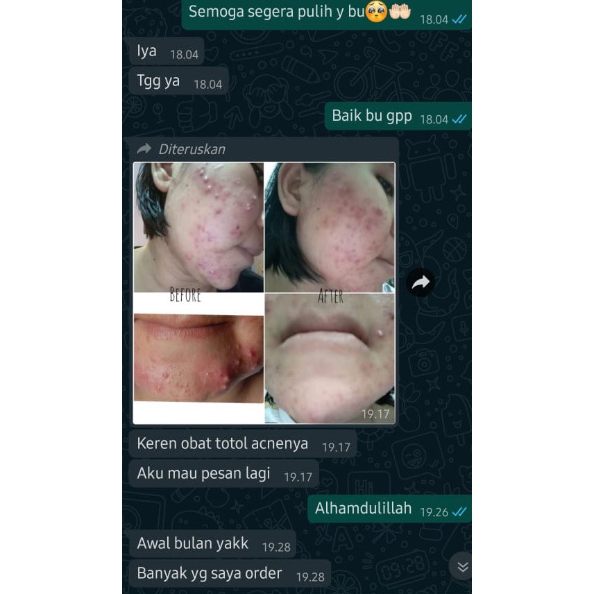 OBAT JERAWAT AMPUH SUDAH BPOM RI | ACNE SPOT CARE | ACNE TREATMENT