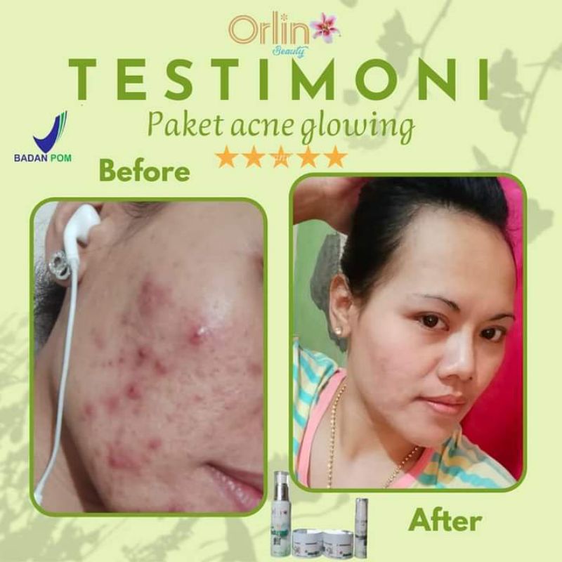 krim penghilang jerawat batu/jerawat menaung/jerawat parah/bopeng/Bruntusan/