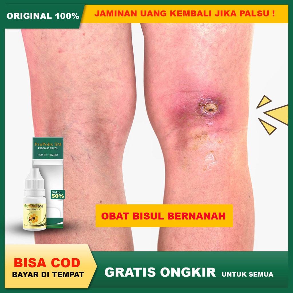 Obat Bisul Benanah, Bisul Di kaki, Di Pantat, Di Kemaluan, Obat Bisul Anak & Dewasa, PROPOLIS SM