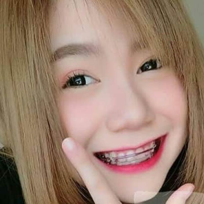 BISA COD] Behel lepas pasang Thailand // Behel THAILAND