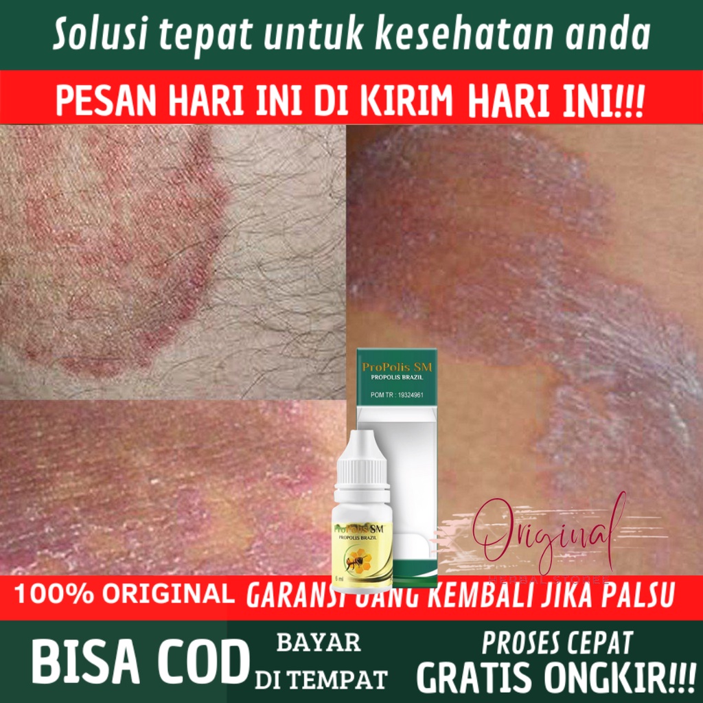 Obat Kurap Selangkangan,Obat Selangkangan Lecet, Obat Iritasi Selangkangan, Obat Selangkangan Sakit 