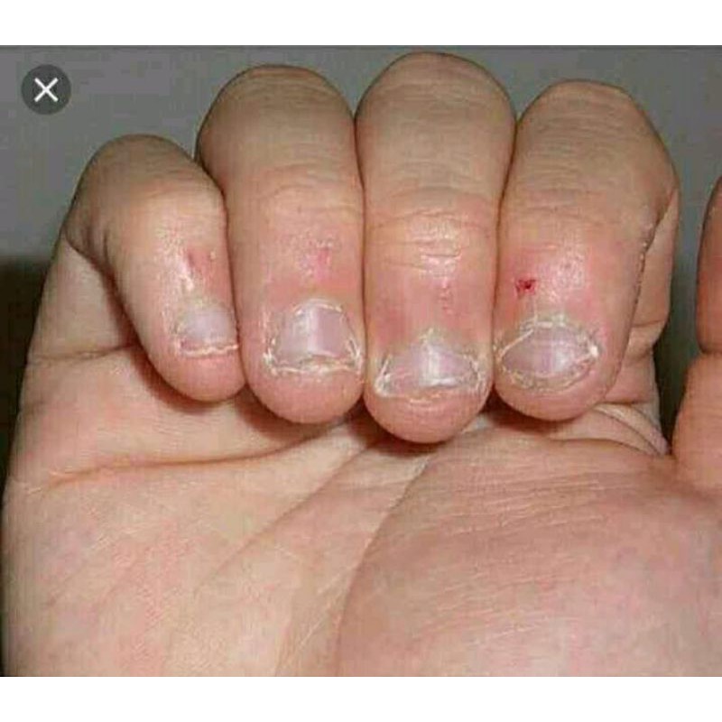 PENUMBUH KUKU DAN PENGHILANG JAMUR KUKU