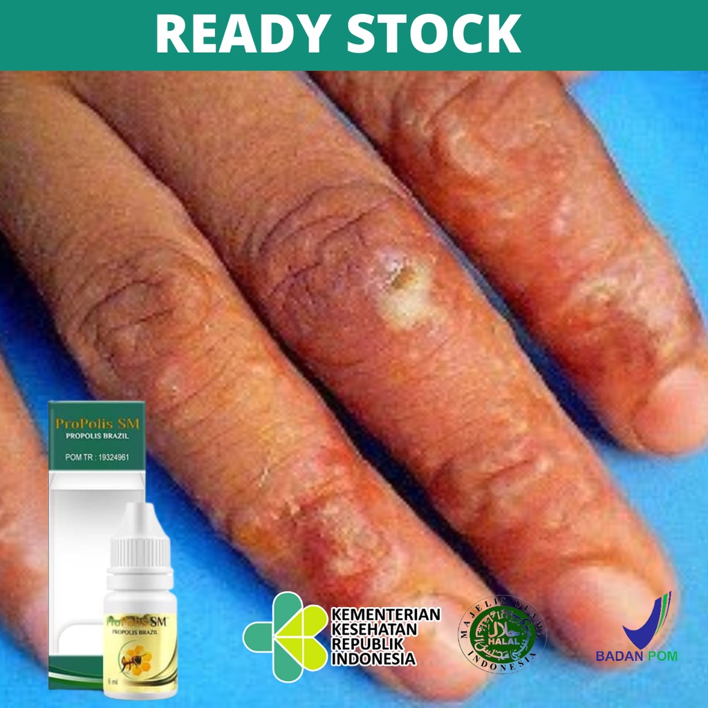 Obat Gatal Scabies Manusia, Salep Scabies Manusia, Obat Gatal Akibat Kutu Scabies, Budug Bernanah, O