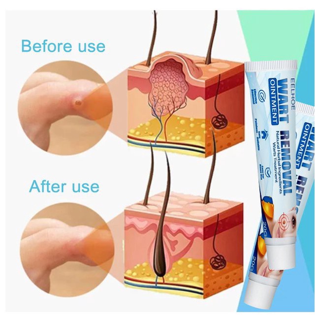 EELHOE Skin Tag Remover Menghilangkan Kutil Tahi Lalat Mata Ikan - Wart Remover Ointment 20g