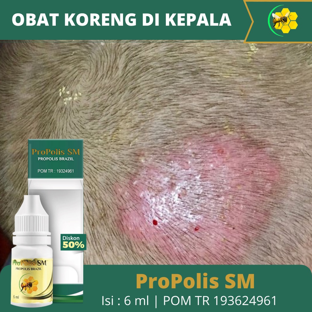 Obat Koreng Di Kepala, Obat Kulit kepala Berkerak, Obat Luka Koreng di Kulit Kepala, Salep Koreng di